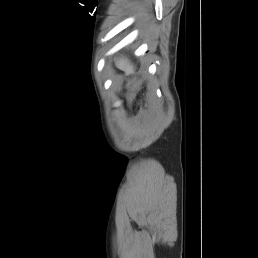 Blunt abdominal trauma with solid organ and musculoskelatal injury with active extravasation (Radiopaedia 68364-77895 C 132).jpg