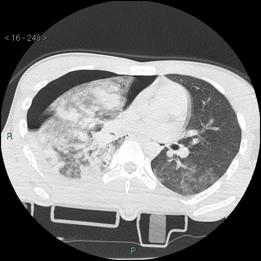 Blunt chest trauma (Swiss cheese sign) (Radiopaedia 38519-40618 Axial lung window 37).jpg