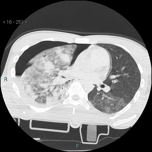 Blunt chest trauma (Swiss cheese sign) (Radiopaedia 38519-40618 Axial lung window 38).jpg