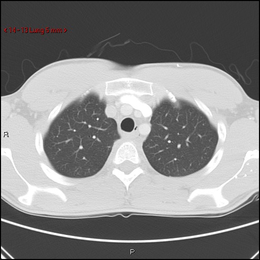 File:Blunt chest trauma - pulmonary interstitial emphysema and pneumomediastinum (Radiopaedia 20666-20552 Axial lung window 13).jpg