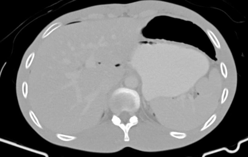 Blunt injury to the small bowel (Radiopaedia 74953-85987 Axial Wide 11).jpg