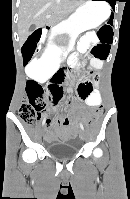 Blunt injury to the small bowel (Radiopaedia 74953-85987 B 37).jpg