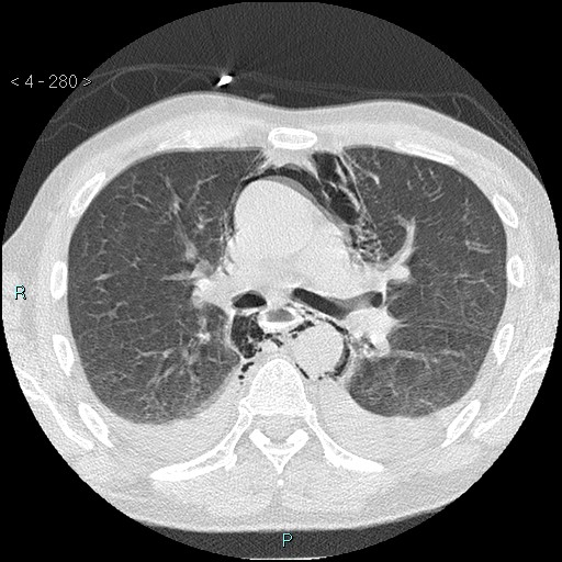 Boerhaave syndrome (Radiopaedia 27683-27897 lung window 32).jpg