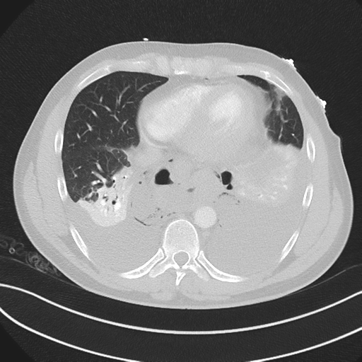 Boerhaave syndrome (Radiopaedia 39382-41660 Axial lung window 39).png