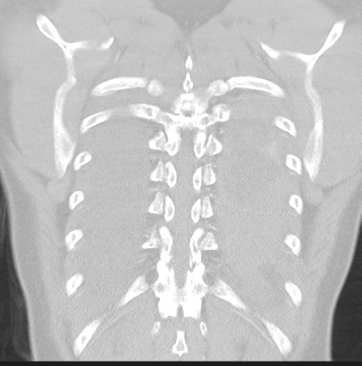 Boerhaave syndrome (Radiopaedia 39382-41661 Coronal lung window 44).png