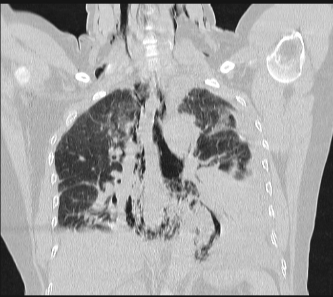 Boerhaave syndrome (Radiopaedia 45644-49799 Coronal lung window 42).jpg