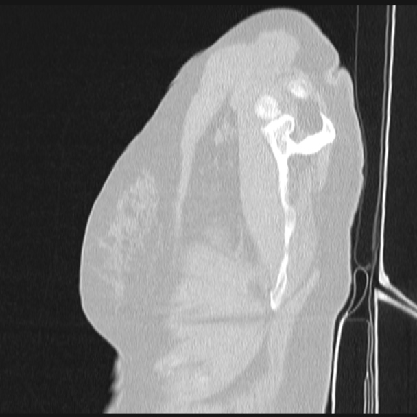 Boerhaave syndrome (Radiopaedia 45644-49799 Sagittal lung window 1).jpg