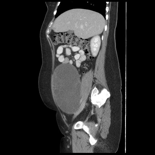 File:Borderline mucinous tumor (ovary) (Radiopaedia 78228-90808 B 23).jpg