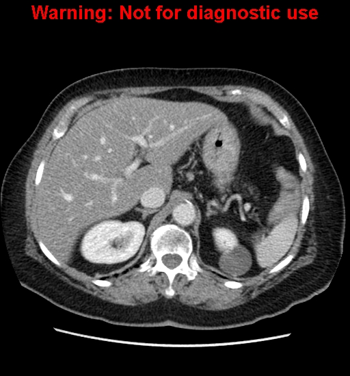 File:Bosniak renal cyst - type II (Radiopaedia 23404-23468 D 18).jpg