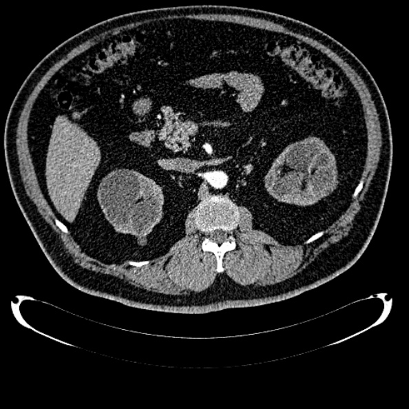 Bosniak renal cyst - type IV (Radiopaedia 24244-24518 B 126).jpg