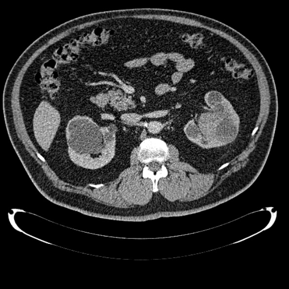Bosniak renal cyst - type IV (Radiopaedia 24244-24518 C 138).jpg