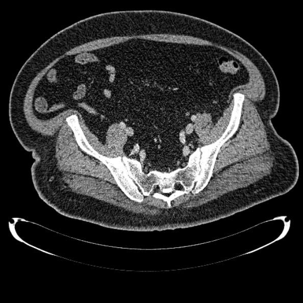 Bosniak renal cyst - type IV (Radiopaedia 24244-24518 C 314).jpg