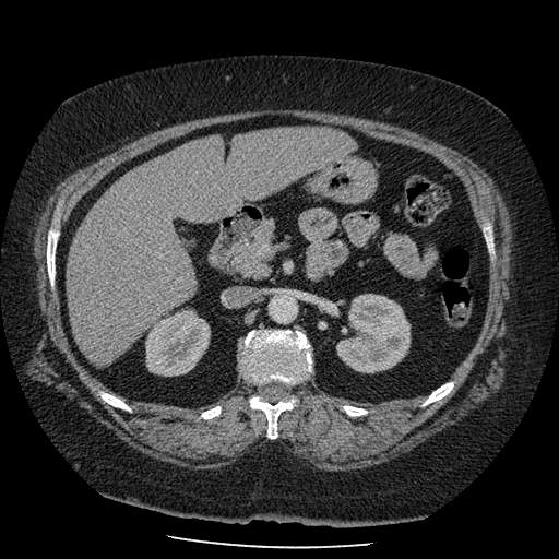 Bovine aortic arch - right internal mammary vein drains into the superior vena cava (Radiopaedia 63296-71875 A 207).jpg