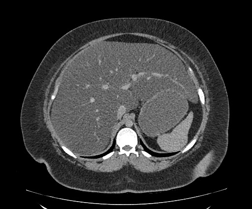 Bowel and splenic infarcts in acute lymphocytic leukemia (Radiopaedia 61055-68913 A 38).jpg