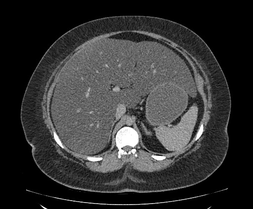 Bowel and splenic infarcts in acute lymphocytic leukemia (Radiopaedia 61055-68913 A 42).jpg