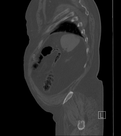 Bowel ischemia secondary to SMA occlusion with extensive portomesenteric venous gas (Radiopaedia 54656-60871 Sagittal bone window 14).jpg