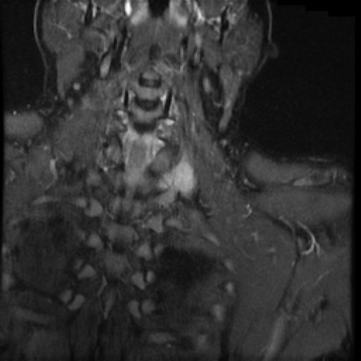 File:Brachial plexus neurofibroma (Radiopaedia 28030-28291 Coronal STIR 4).png