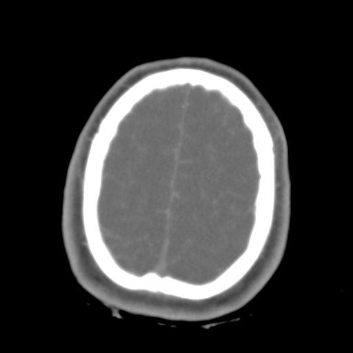 Brain contusions, internal carotid artery dissection and base of skull fracture (Radiopaedia 34089-35339 D 10).png