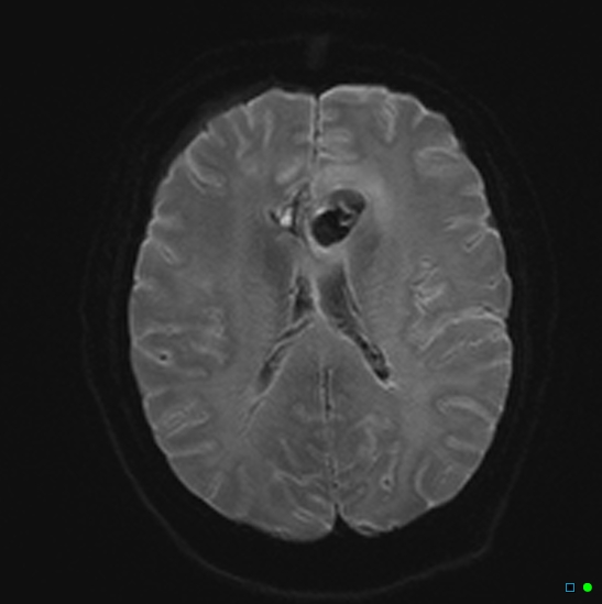 File:Brain death on MRI and CT angiography (Radiopaedia 42560-45689 Axial DWI 16).jpg