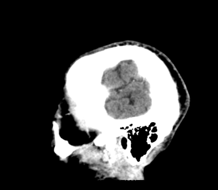 Brain metastases from lung cancer (Radiopaedia 27849-28092 Sagittal C+ delayed 55).jpg