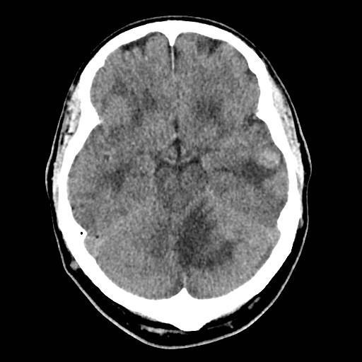 File:Brain metastases from lung cancer (Radiopaedia 83839-99027 Axial non-contrast 12).jpg