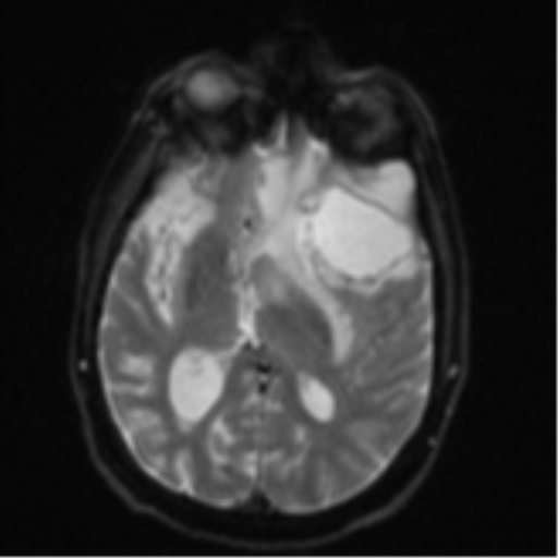 File:Brain metastasis (lung cancer) (Radiopaedia 48289-53179 Axial DWI 14).png