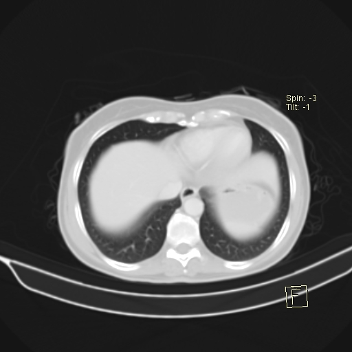File:Brain metastasis as initial presentation of non-small cell lung cancer (Radiopaedia 65122-74127 Axial lung window 38).jpg