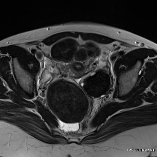 File:Broad ligament fibroid (Radiopaedia 49135-54241 Axial T2 18).jpg