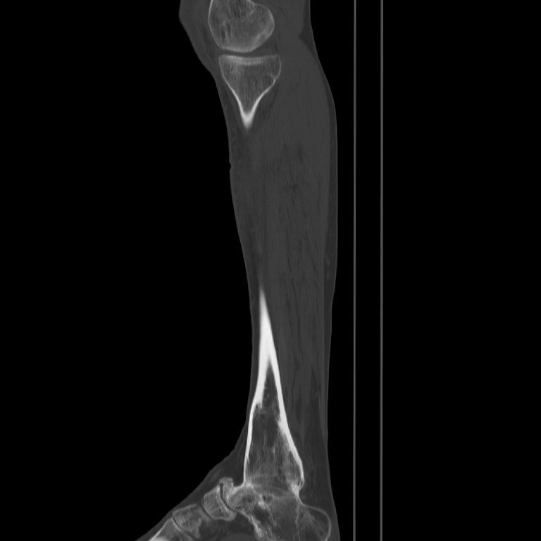 Brodie abscess - tibia (Radiopaedia 66028-75204 Sagittal bone window 15).jpg