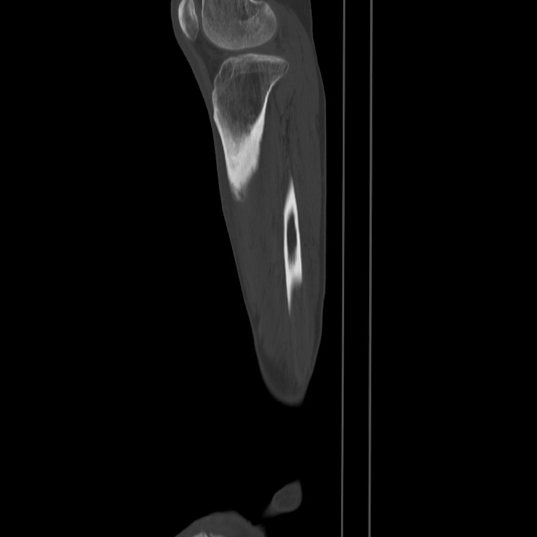 Brodie abscess - tibia (Radiopaedia 66028-75204 Sagittal bone window 60).jpg