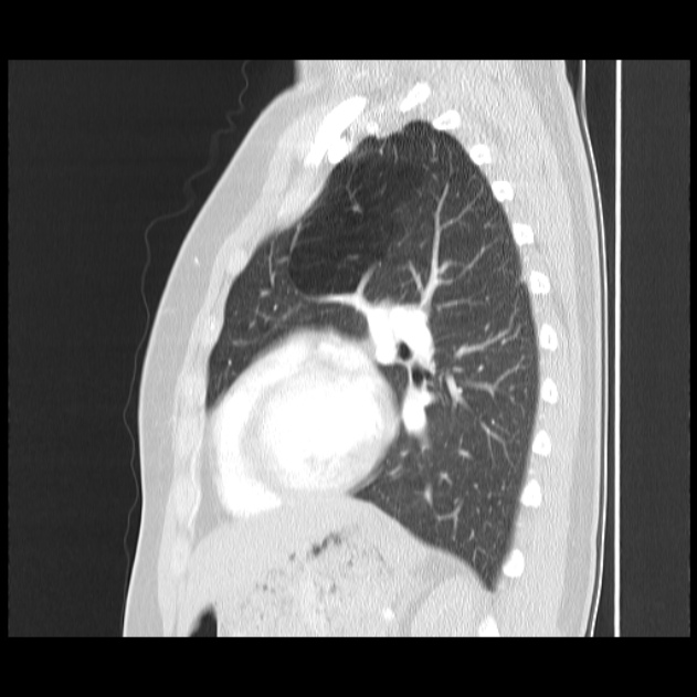 Bronchial atresia (Radiopaedia 22965-22992 Sagittal lung window 21).jpg