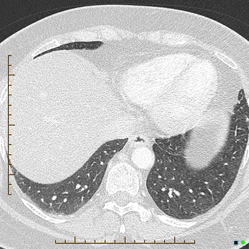 Bronchial diverticula (Radiopaedia 79512-92676 Axial lung window 165).jpg