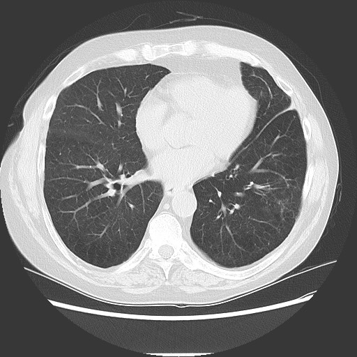 Bronchial stenosis - lung transplant (Radiopaedia 73133-83848 Axial lung window 40).jpg