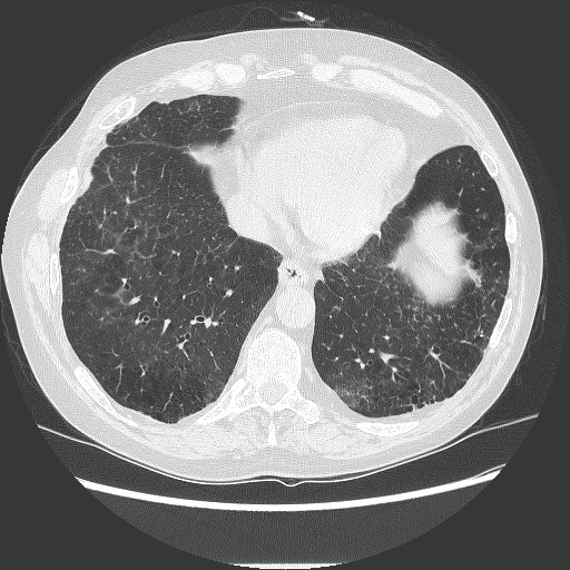File:Bronchial stenosis - lung transplant (Radiopaedia 73133-83848 B 24).jpg