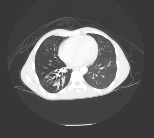 File:Bronchiectasis in Crohn disease (Radiopaedia 60311-67977 Axial lung window 2).jpg