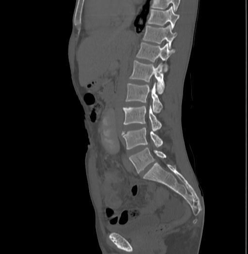 Bronchiectasis in Crohn disease (Radiopaedia 60311-67977 Sagittal bone window 111).jpg