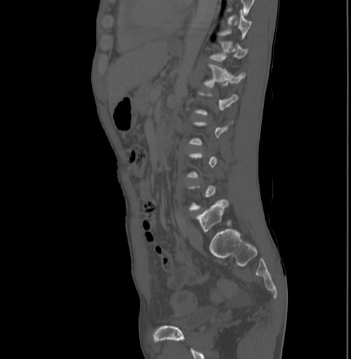 Bronchiectasis in Crohn disease (Radiopaedia 60311-67977 Sagittal bone window 152).jpg