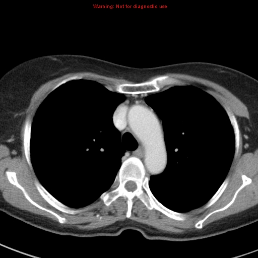 File:Bronchoalveolar carcinoma (BAC) (Radiopaedia 13436-13392 B 17).jpg