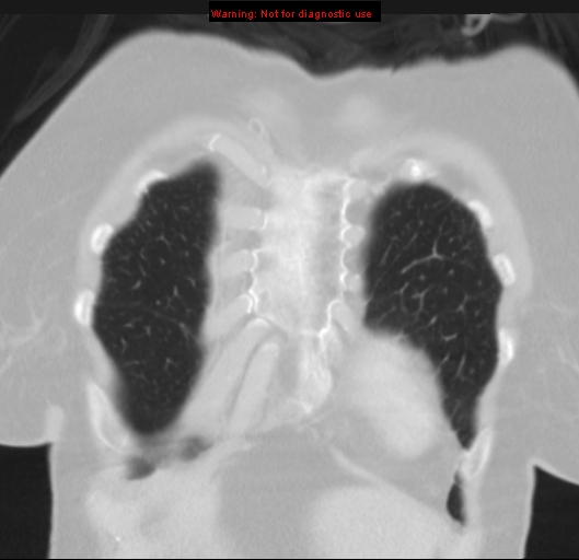 Bronchoalveolar carcinoma (BAC) (Radiopaedia 13436-13392 Coronal lung window 9).jpg