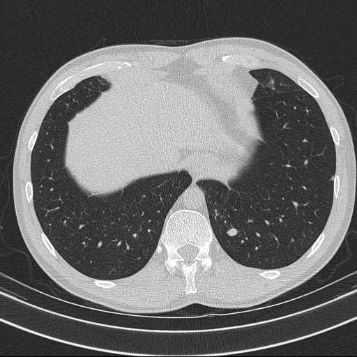 File:Bronchocele (Radiopaedia 60676-68429 Axial lung window 61).jpg