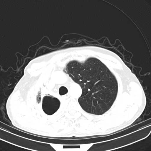 Bronchopleural fistula - postoperative complication (Radiopaedia 21020-20947 Axial lung window 16).jpg
