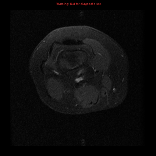 File:Brown tumor (Radiopaedia 12318-12597 Axial T1 C+ fat sat 2).jpg