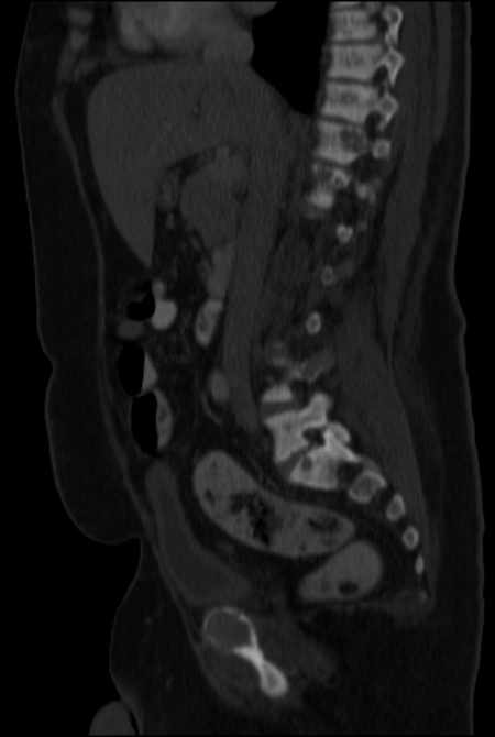 Brown tumors compressing the spinal cord (Radiopaedia 68442-77988 H 26).jpg
