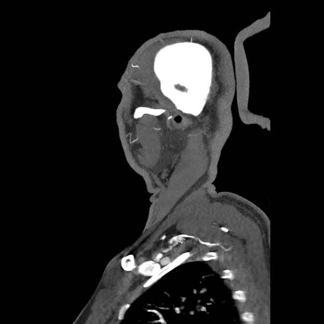 Buccal fat pad arteriovenous malformation (Radiopaedia 70936-81144 C 68).jpg