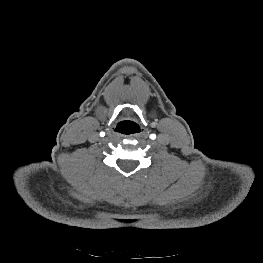 Buccal fat pad arteriovenous malformation (Radiopaedia 70936-81144 D 124).jpg