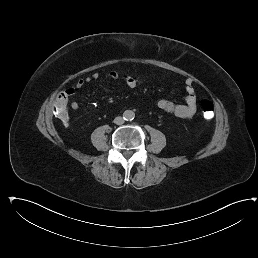 Buried bumper syndrome - gastrostomy tube (Radiopaedia 63843-72577 Axial Inject 71).jpg