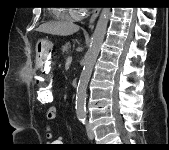 Buried bumper syndrome - gastrostomy tube (Radiopaedia 63843-72577 Sagittal Inject 59).jpg