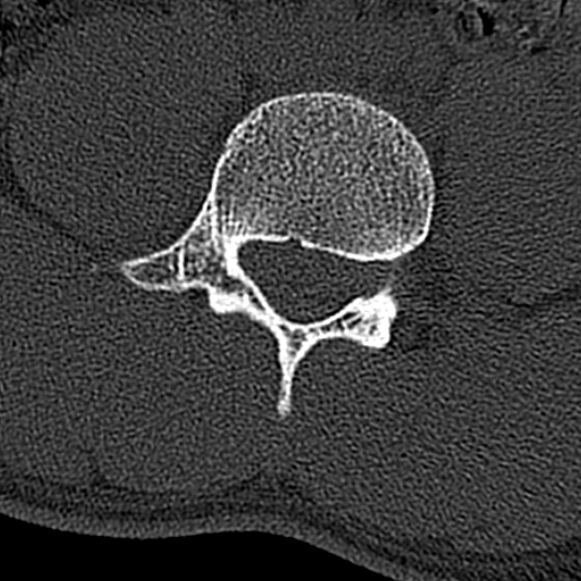 Burst fracture (Radiopaedia 53373-59357 Axial bone window 47).jpg