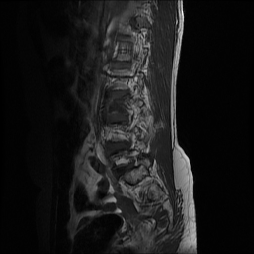 File:Burst fracture - lumbar spine (Radiopaedia 72877-83541 Sagittal T1 1).jpg