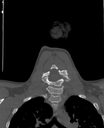 File:Butterfly vertebra (Radiopaedia 77903-90209 Coronal bone window 42).jpg